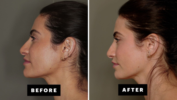 before and after images of facial grafting under the eyes and in the temples on a woman. her hair is pulled back she is...
